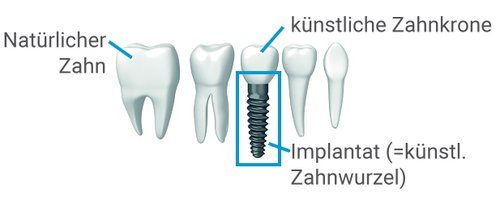 Schaubild natürlicher Zahn versus Implantat mit Krone