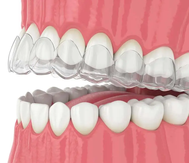 3D-Darstellung einer transparenten Invisalign-Schiene, die passgenau &uuml;ber die Z&auml;hne gesetzt wird
